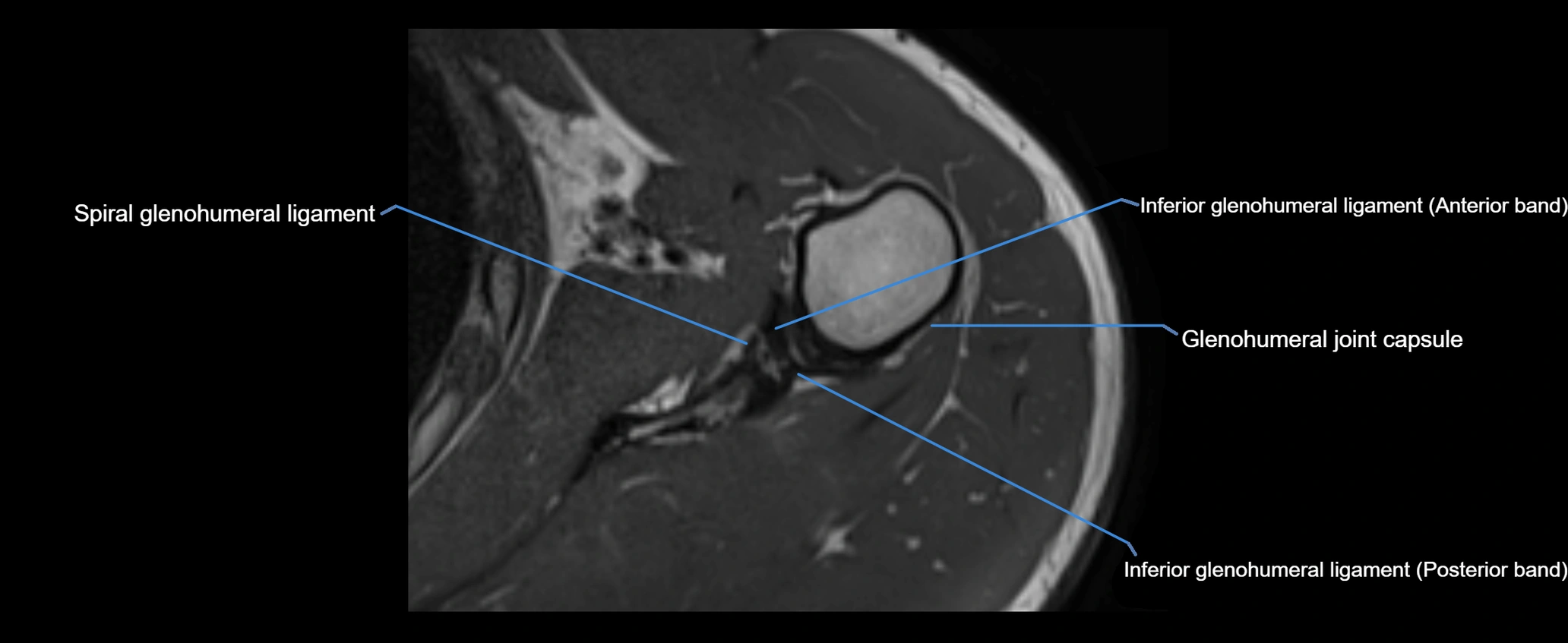 shoulder ligaments axial 3d 3t mri image-img-00005-00086.webp